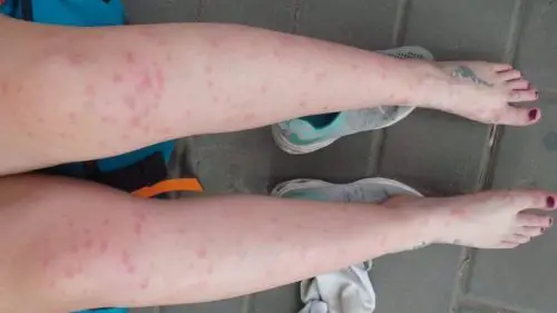 Mosquito bites - Beijing, China